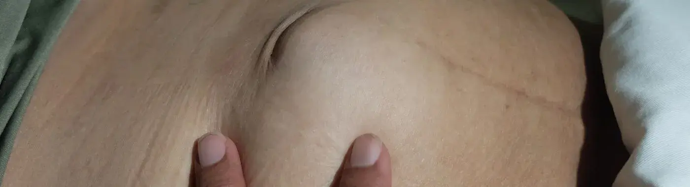 Ventral Hernia - Causes, Symptoms, Diagnosis, Treatment, and Prevention