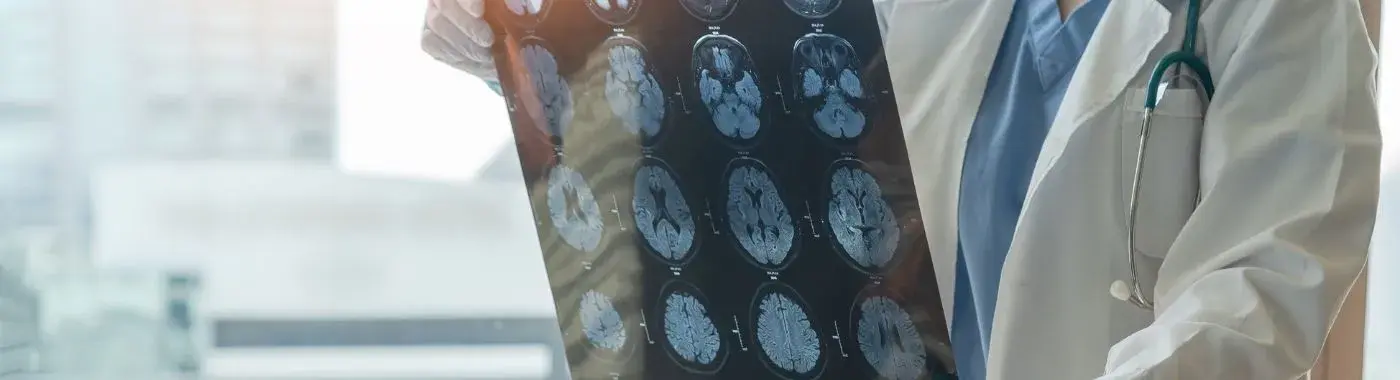 Alexander Disease - Causes, Symptoms, Diagnosis, Treatment, and Prevention