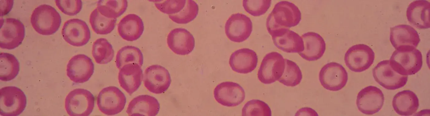 Beta Thalassemia - Causes, Symptoms, Diagnosis, Treatment, and Prevention