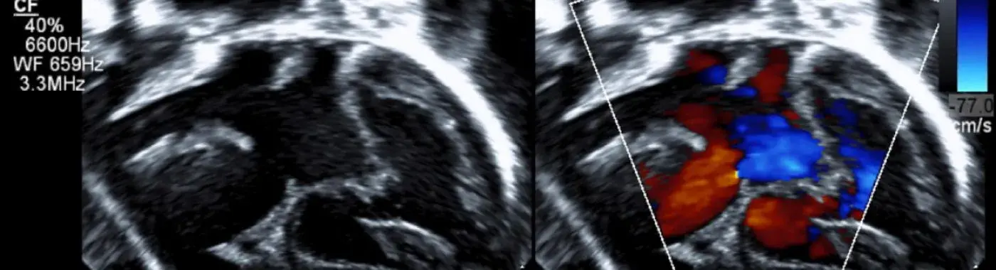 Bicuspid Aortic Valve - Causes, Symptoms, Diagnosis, Treatment, and Prevention