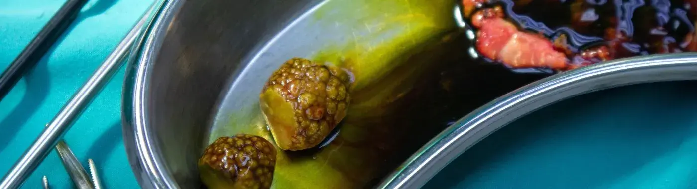 Bladder Stones - Causes, Symptoms, Diagnosis, Treatment, and Prevention