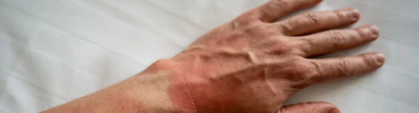 Bloom Syndrome - Causes, Symptoms, Diagnosis, Treatment, and Prevention