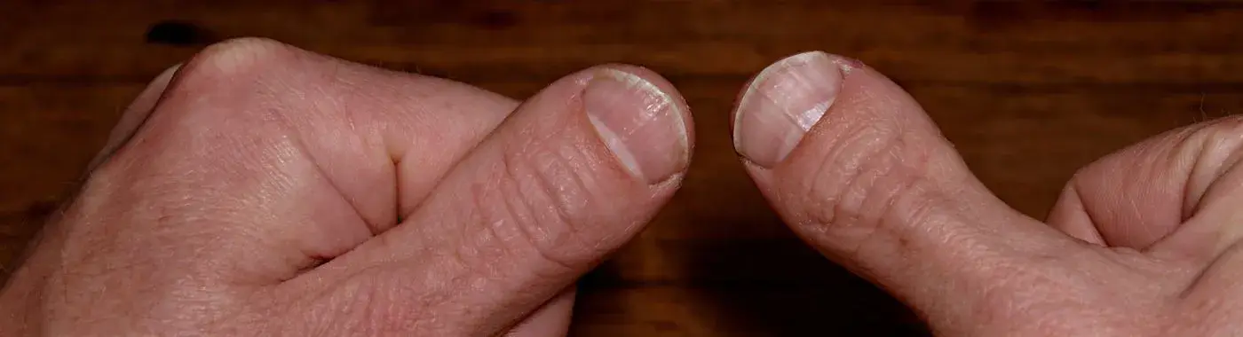 Brachydactyly - Causes, Symptoms, Diagnosis, Treatment, and Prevention