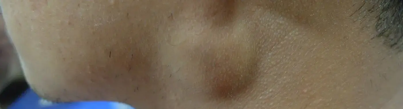 Branchial Cleft Cyst - Causes, Symptoms, Diagnosis, Treatment, and Prevention