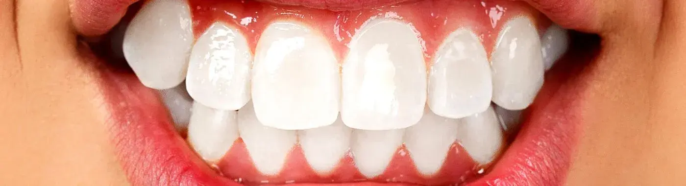 Bruxism - Causes, Symptoms, Diagnosis, Treatment, and Prevention