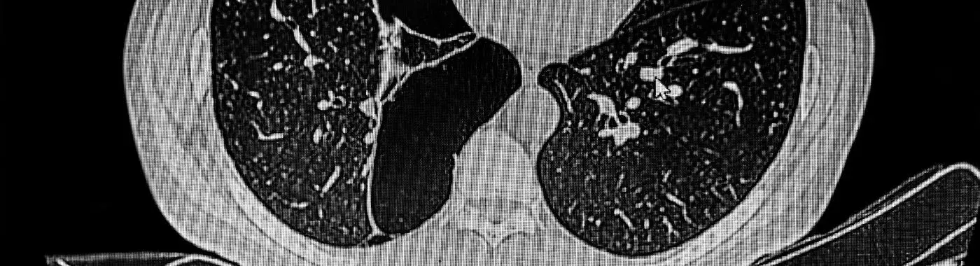 Bullous Emphysema - Causes, Symptoms, Diagnosis, Treatment, and Prevention