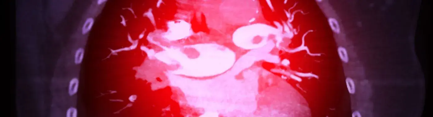 Embolism - Causes, Symptoms, Diagnosis, Treatment, and Prevention