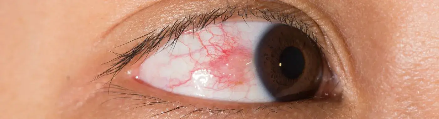 Episcleritis - Causes, Symptoms, Diagnosis, Treatment, and Prevention