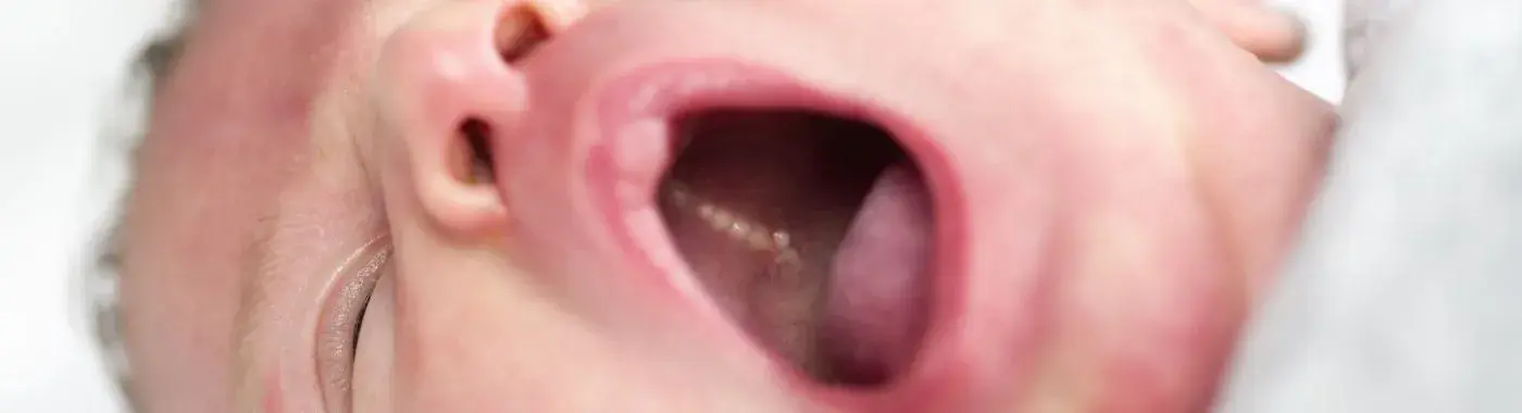 Epstein Pearls - Causes, Symptoms, Diagnosis, Treatment, and Prevention