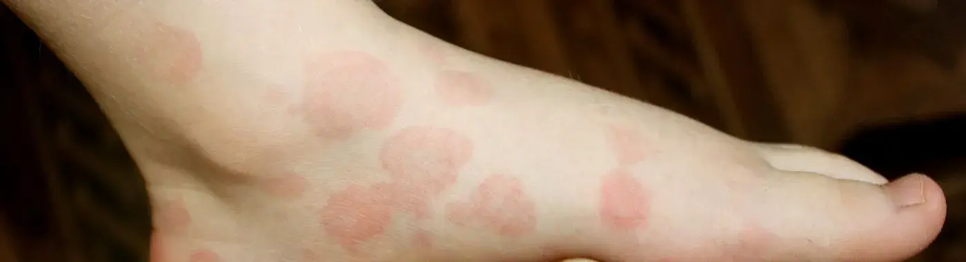 Erythema Multiforme - Causes, Symptoms, Diagnosis, Treatment, and Prevention