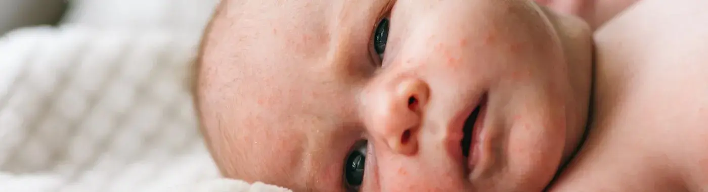 Erythema Toxicum Neonatorum - Causes, Symptoms, Diagnosis, and Treatment