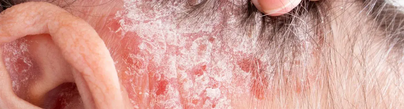 Erythrodermic Psoriasis - Causes, Symptoms, Diagnosis, Treatment, and Prevention