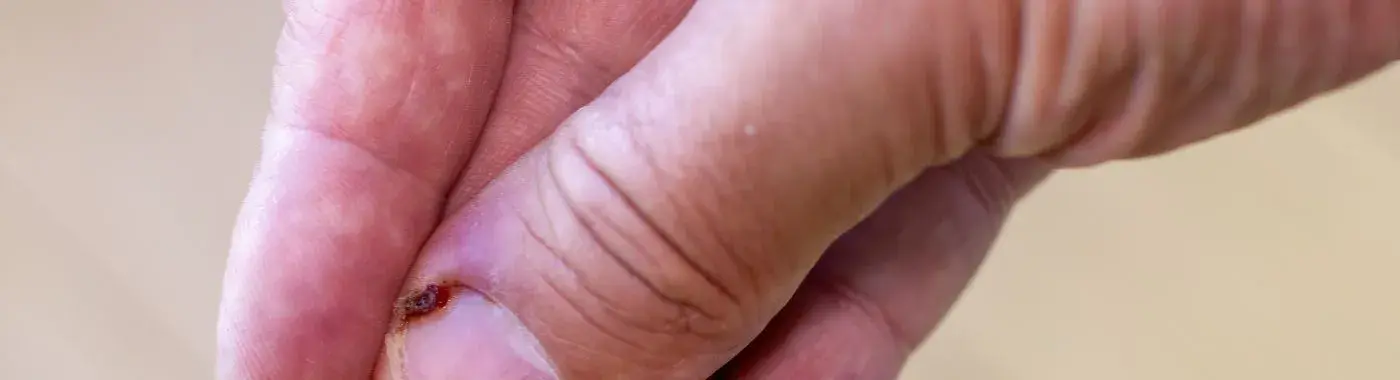 Felon Finger - Causes, Symptoms, Diagnosis, Treatment, and Prevention