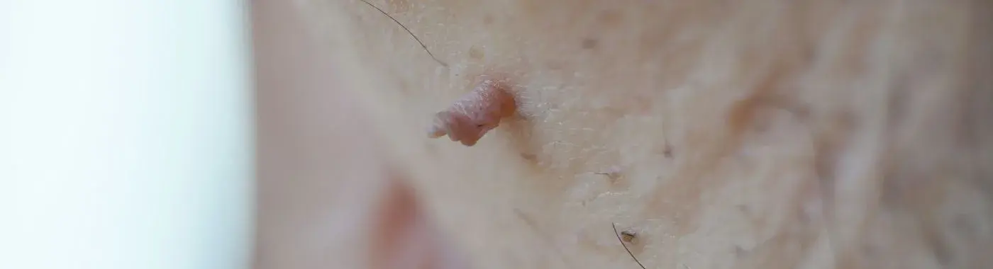 Fibroma - Causes, Symptoms, Diagnosis, Treatment, and Prevention