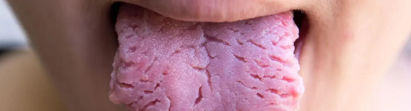 Fissured Tongue - Causes, Symptoms, Diagnosis, Treatment, and Prevention