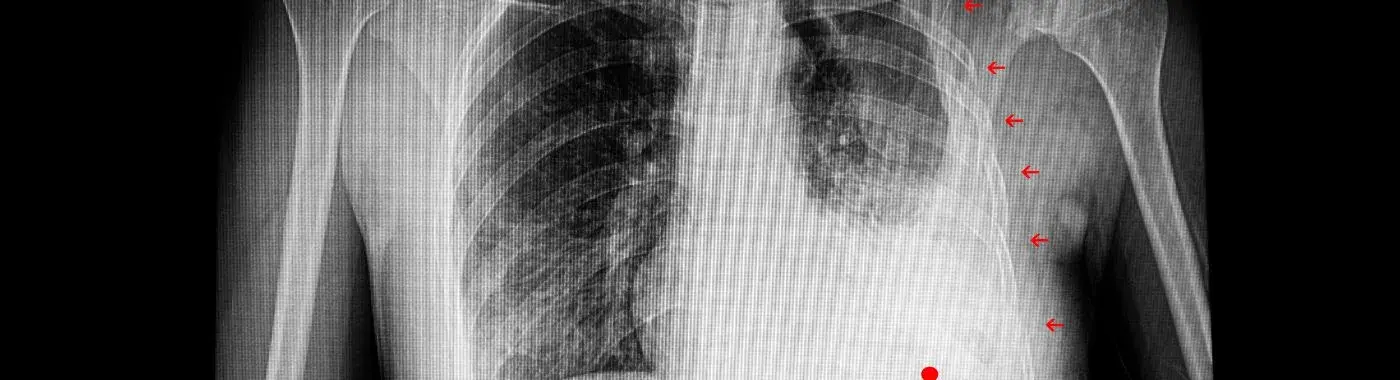 Flail Chest - Causes, Symptoms, Diagnosis, Treatment, and Prevention