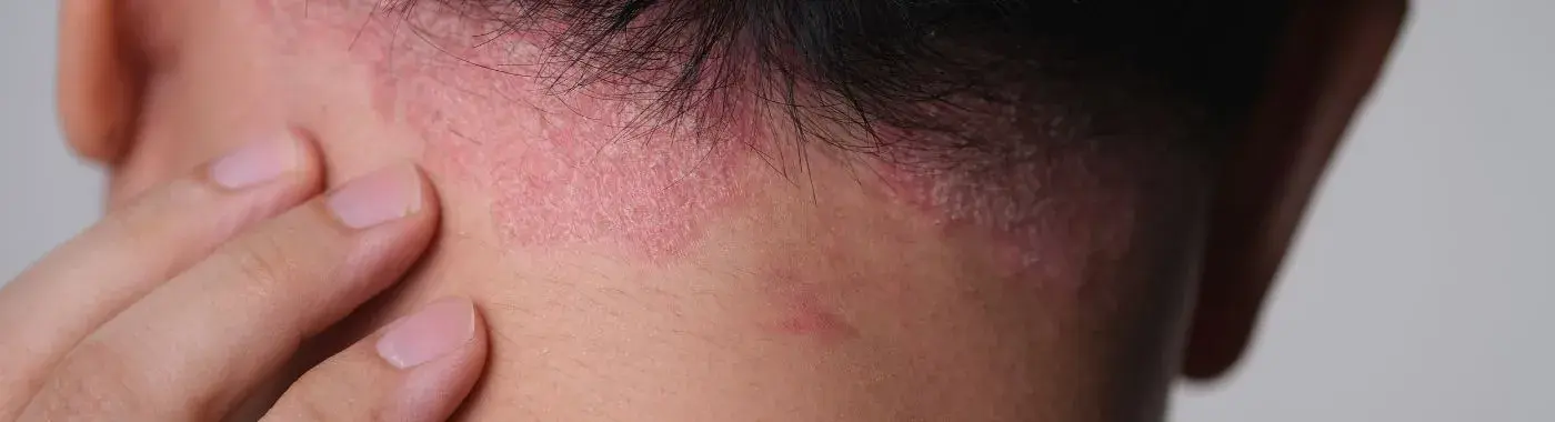 Folliculitis Decalvans - Causes, Symptoms, Diagnosis, Treatment, and Prevention