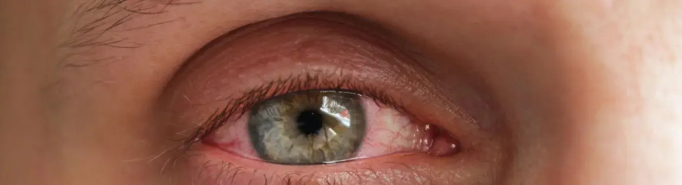 Giant Papillary Conjunctivitis - Causes, Symptoms, Diagnosis, Treatment, and Prevention