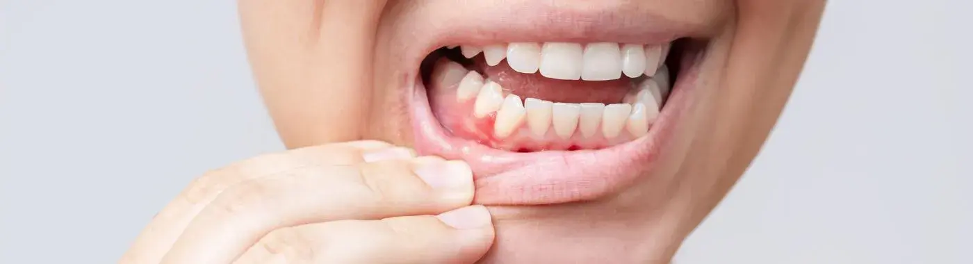 Gingivostomatitis - Causes, Symptoms, Diagnosis, Treatment, and Prevention
