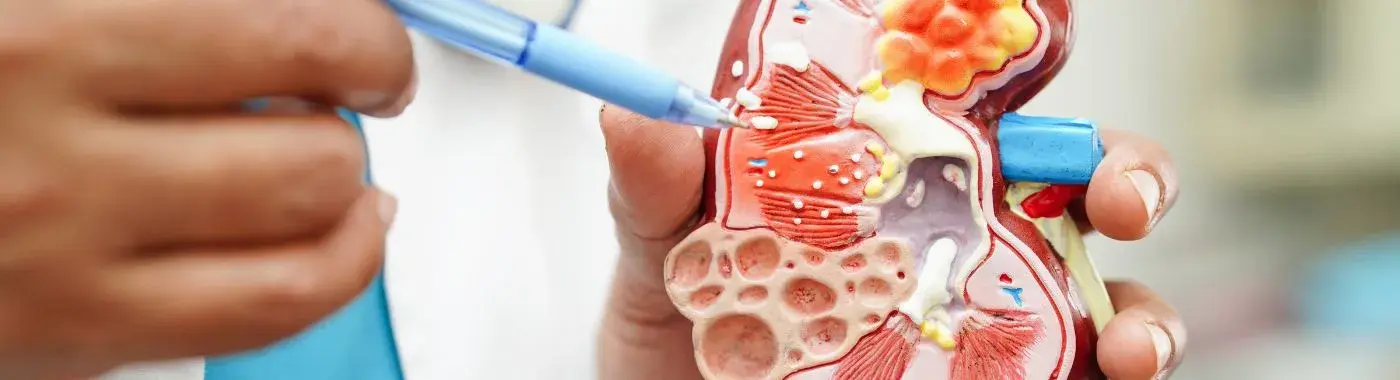 Glomerular Diseases - Causes, Symptoms, Diagnosis, Treatment, and Prevention