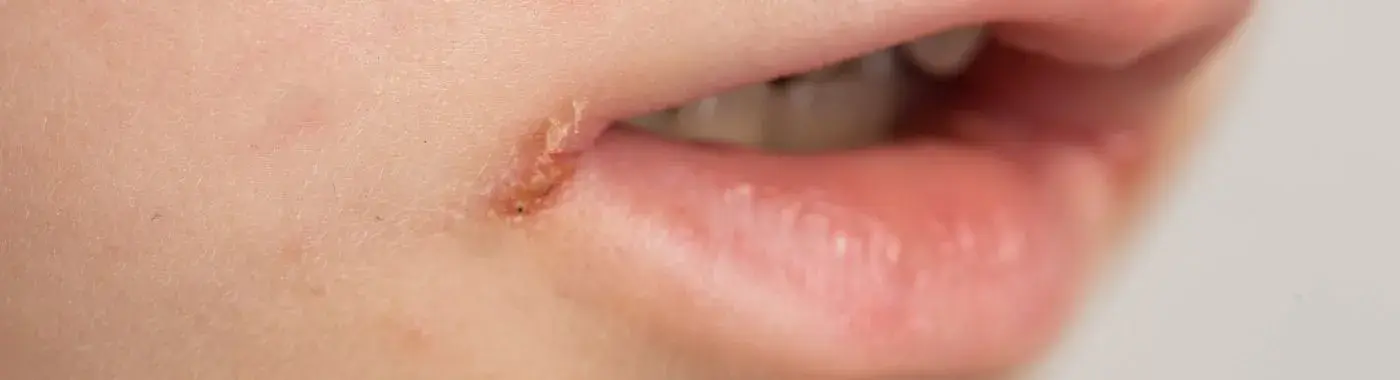 Granulomatous Cheilitis - Causes, Symptoms, Diagnosis, Treatment, and Prevention
