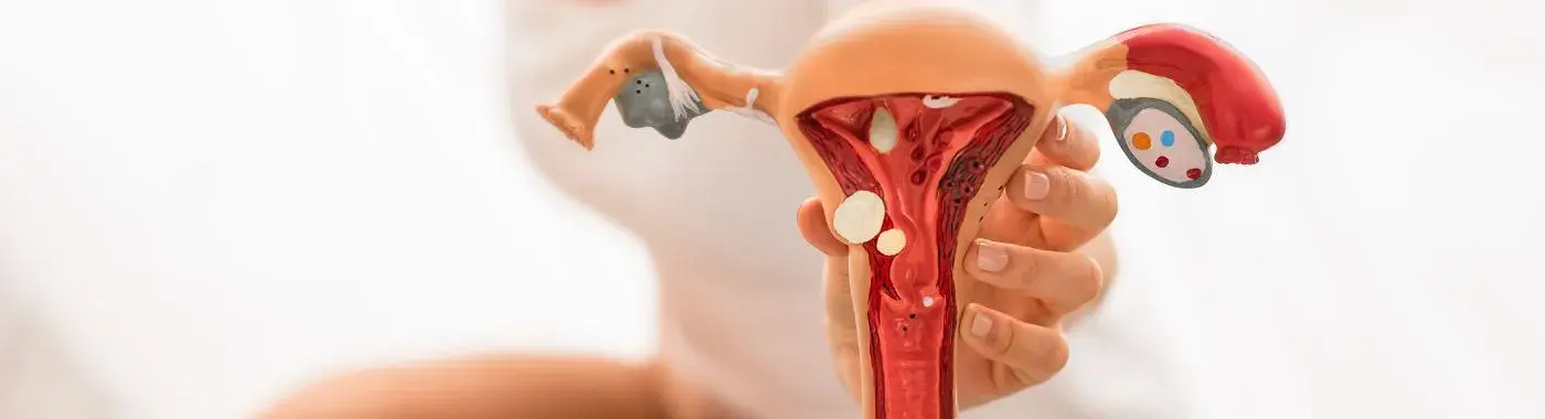 Granulosa Cell Tumor - Causes, Symptoms, Diagnosis, Treatment, and Prevention