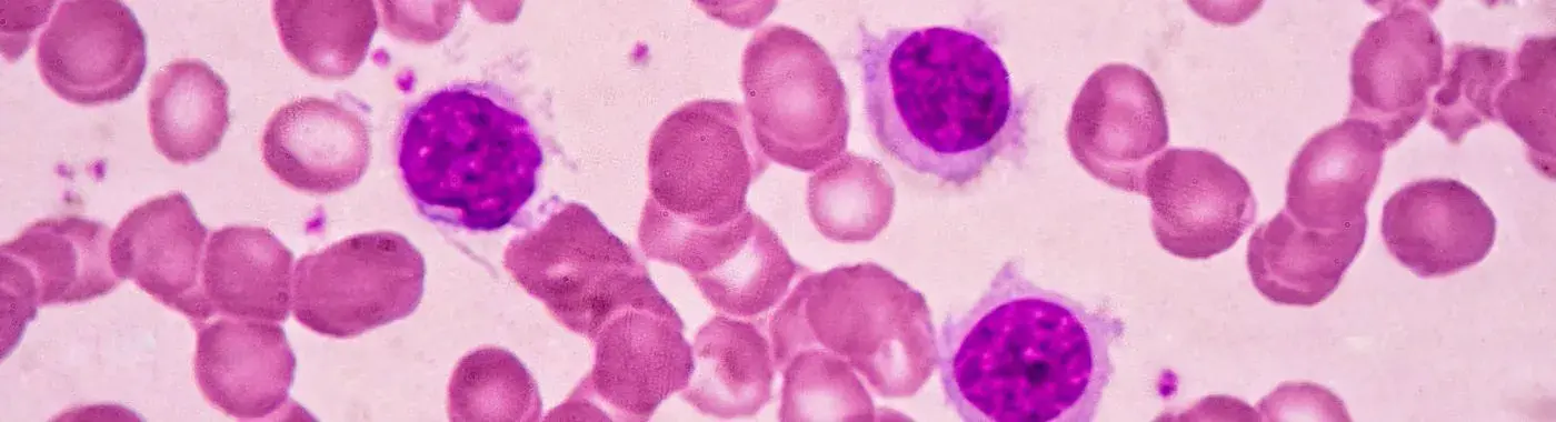 Hairy Cell Leukemia - Causes, Symptoms, Diagnosis, Treatment, and Prevention
