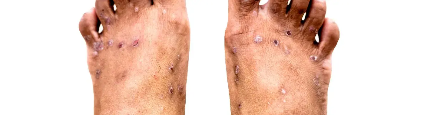 Hand Foot Syndrome - Causes, Symptoms, Diagnosis, Treatment, and Prevention