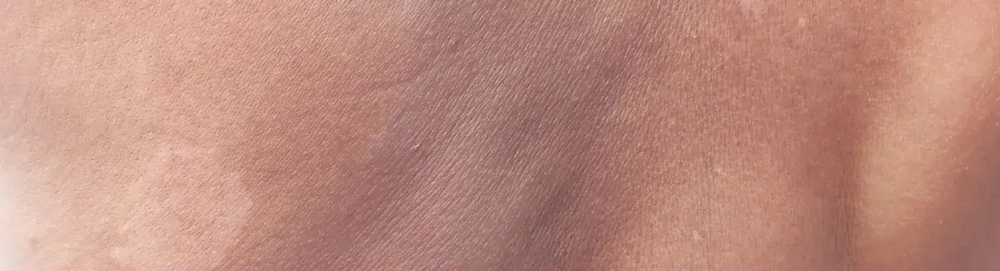 Harlequin Syndrome - Causes, Symptoms, Diagnosis, Treatment, and Prevention