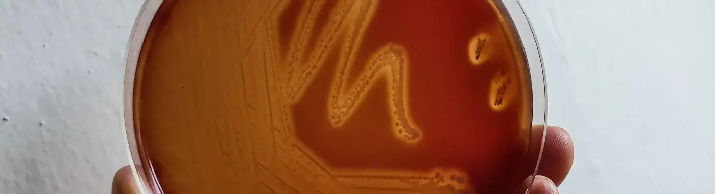 Hemolysis - Causes, Symptoms, Diagnosis, Treatment, and Prevention