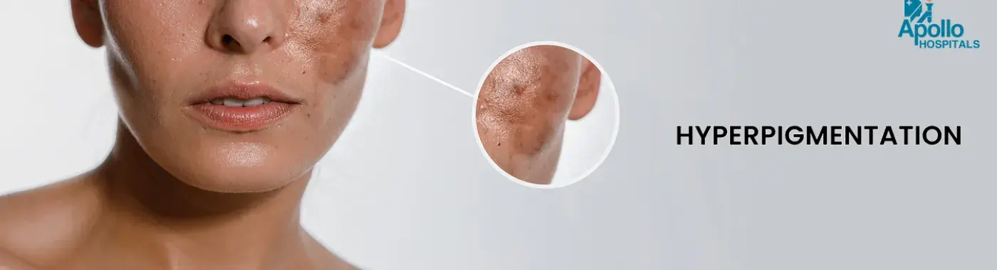 Hyperpigmentation