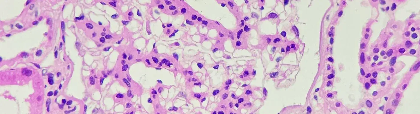 Iga Nephropathy - Causes, Symptoms, Diagnosis, Treatment, and Prevention