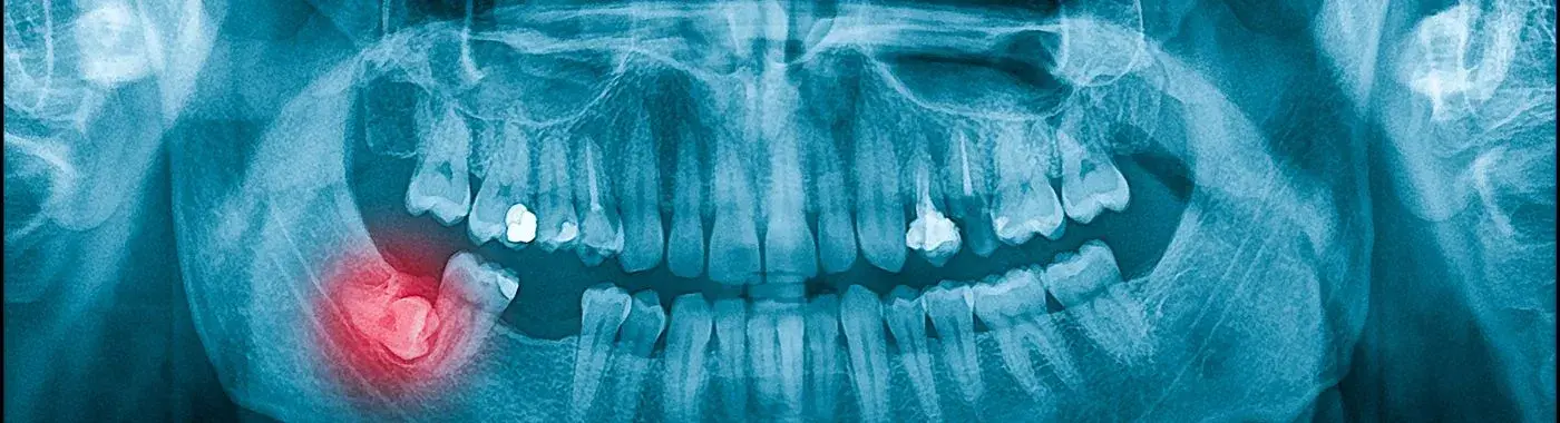Impacted Tooth - Causes, Symptoms, Diagnosis, Treatment, and Prevention