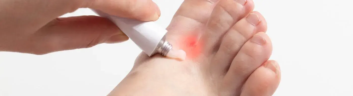 Intertrigo - Causes, Symptoms, Diagnosis, Treatment, and Prevention