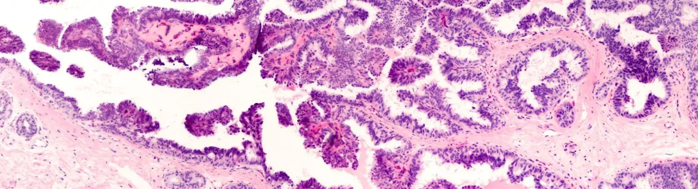 Intraductal Papilloma - Causes, Symptoms, Diagnosis, Treatment, and Prevention