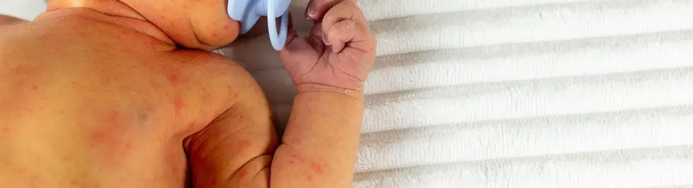 Jaundice In Newborns - Causes, Symptoms, Diagnosis, Treatment, and Prevention