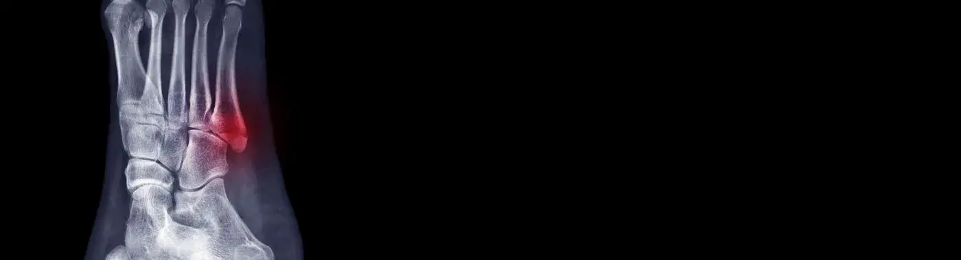 Jones Fracture - Causes, Symptoms, Diagnosis, Treatment, and Prevention