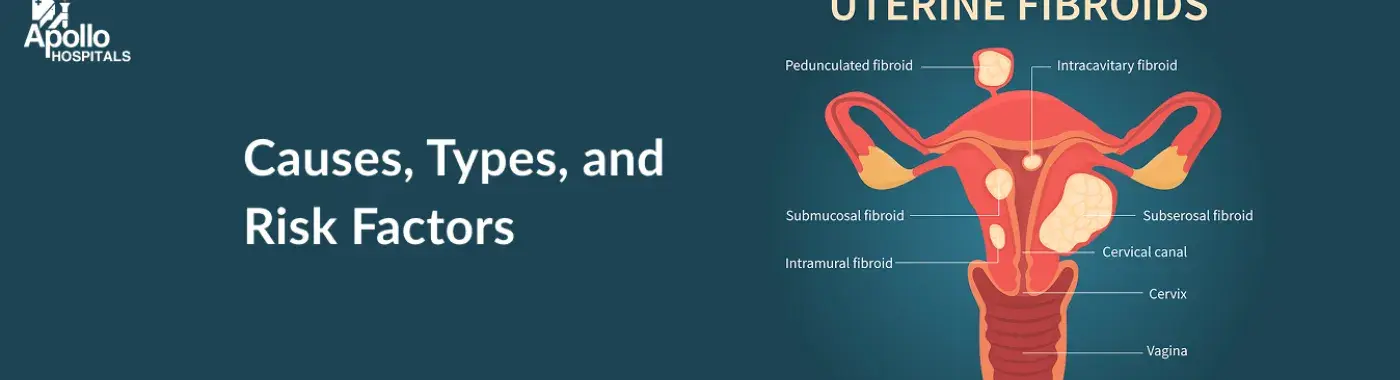 Uterine Fibroids: Causes, Symptoms, Types, and Treatment Options