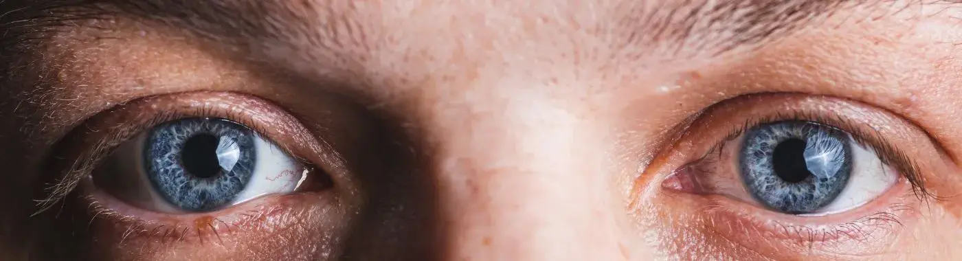 Waardenburg Syndrome - Causes, Symptoms, Diagnosis, Treatment, and Prevention