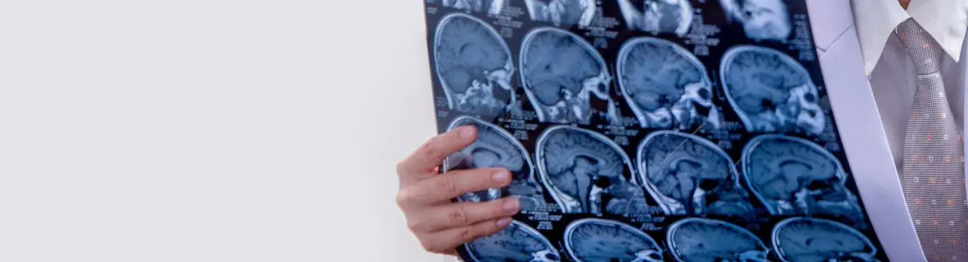 Weber Syndrome - Causes, Symptoms, Diagnosis, Treatment, and Prevention