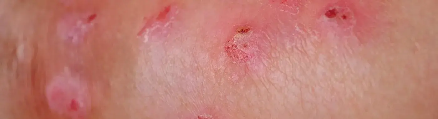 Weeping Eczema - Causes, Symptoms, Diagnosis, Treatment, and Prevention