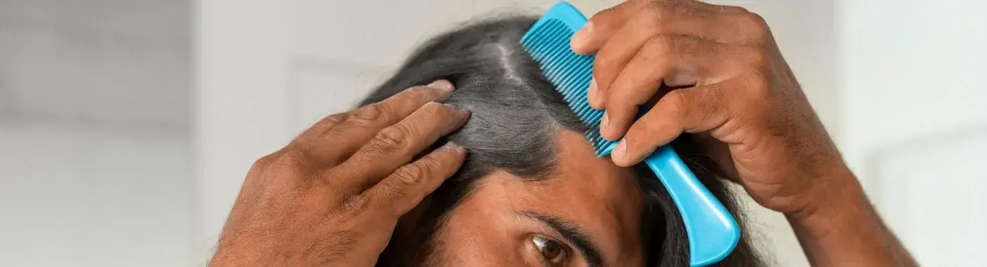 Alopecia Areata - Causes, Symptoms, Diagnosis, Treatment, and Prevention