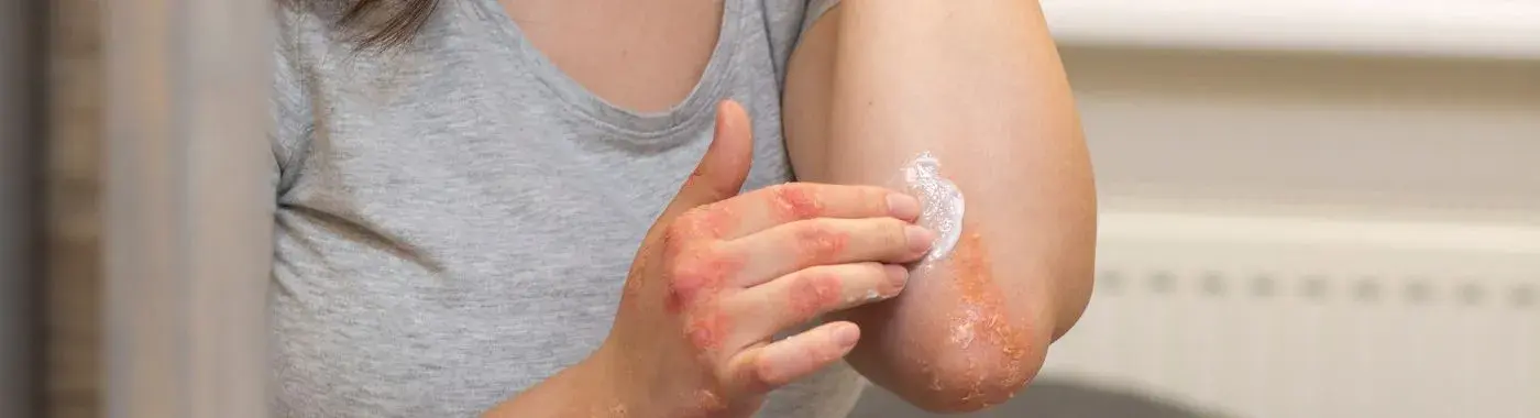 Atopic Dermatitis - Causes, Symptoms, Diagnosis, Treatment, and Prevention