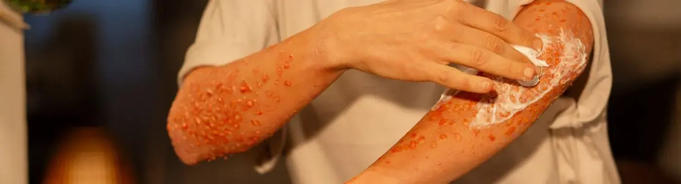 Burns - Causes, Symptoms, Diagnosis, Treatment, and Prevention