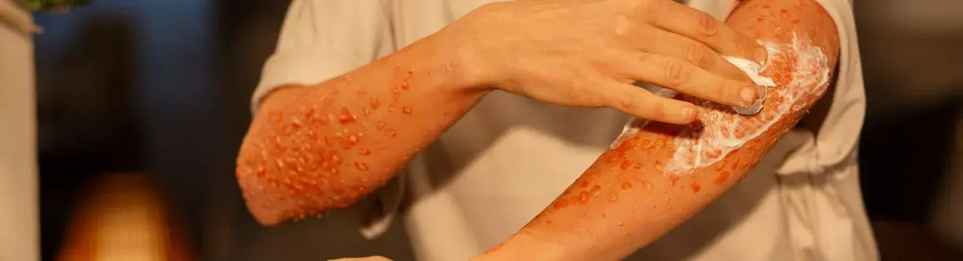 Epidermolysis Bullosa - Causes, Symptoms, Diagnosis, Treatment, and Prevention