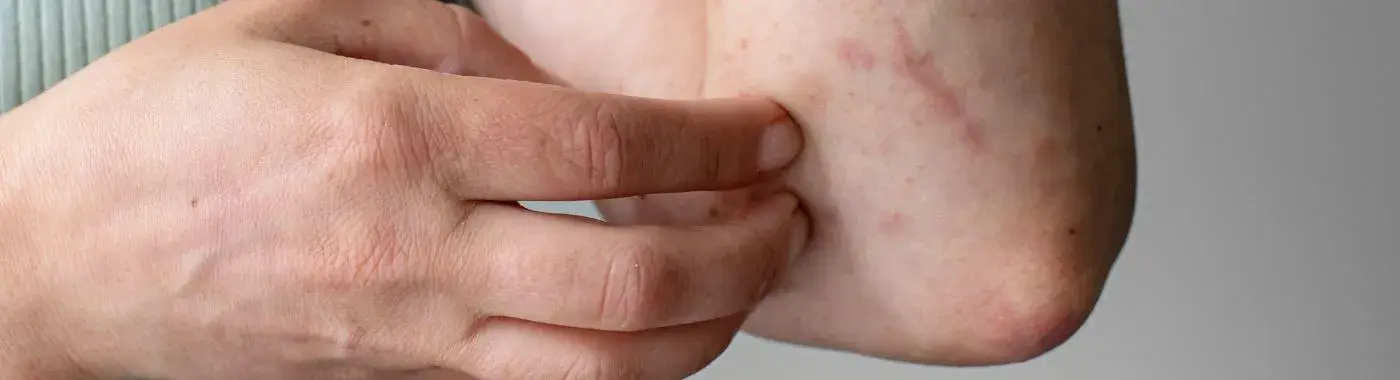 Genital Warts - Causes, Symptoms, Diagnosis, Treatment, and Prevention