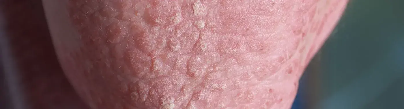 Henoch Schonlein Purpura - Causes, Symptoms, Diagnosis, Treatment, and Prevention