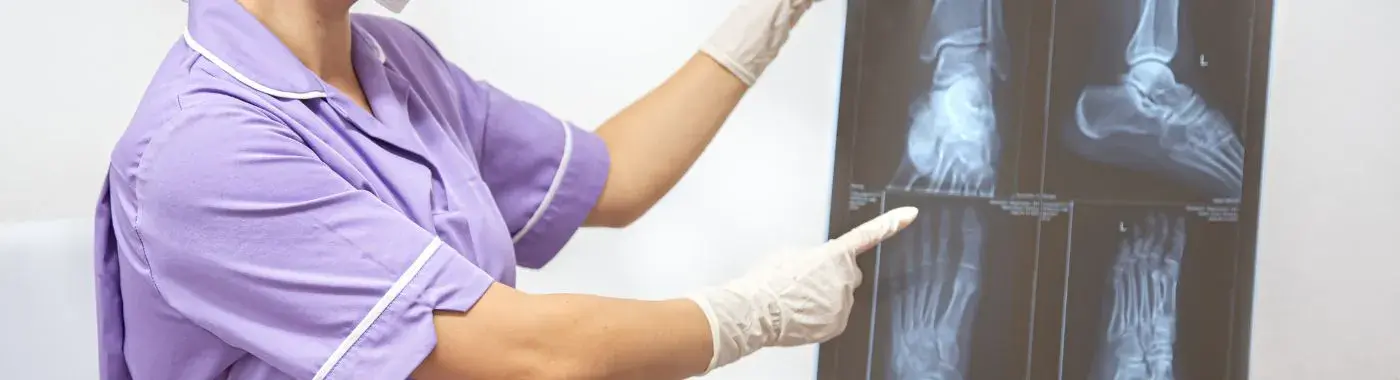 Hypertrophic Osteoarthropathy - Causes, Symptoms, Diagnosis, Treatment, and Prevention