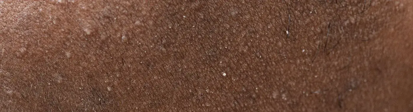 Keratosis Pilaris - Causes, Symptoms, Diagnosis, Treatment, and Prevention