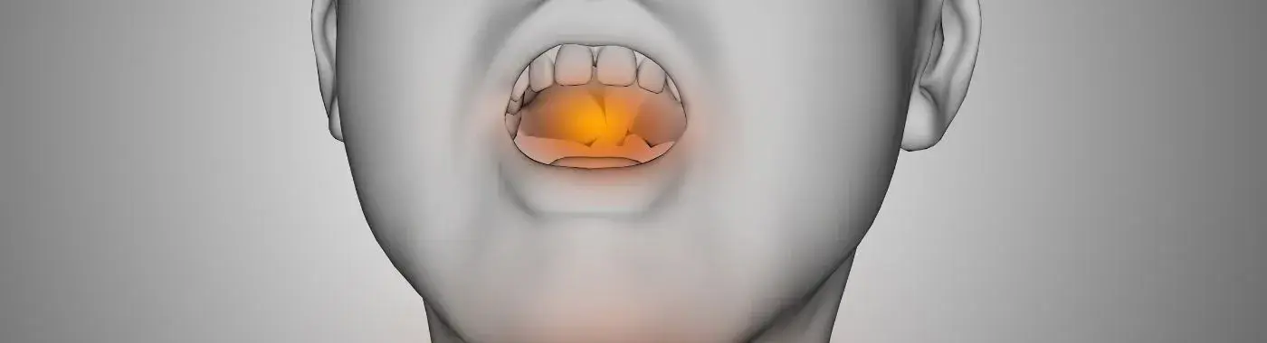 Ludwigs Angina - Causes, Symptoms, Diagnosis, Treatment, and Prevention